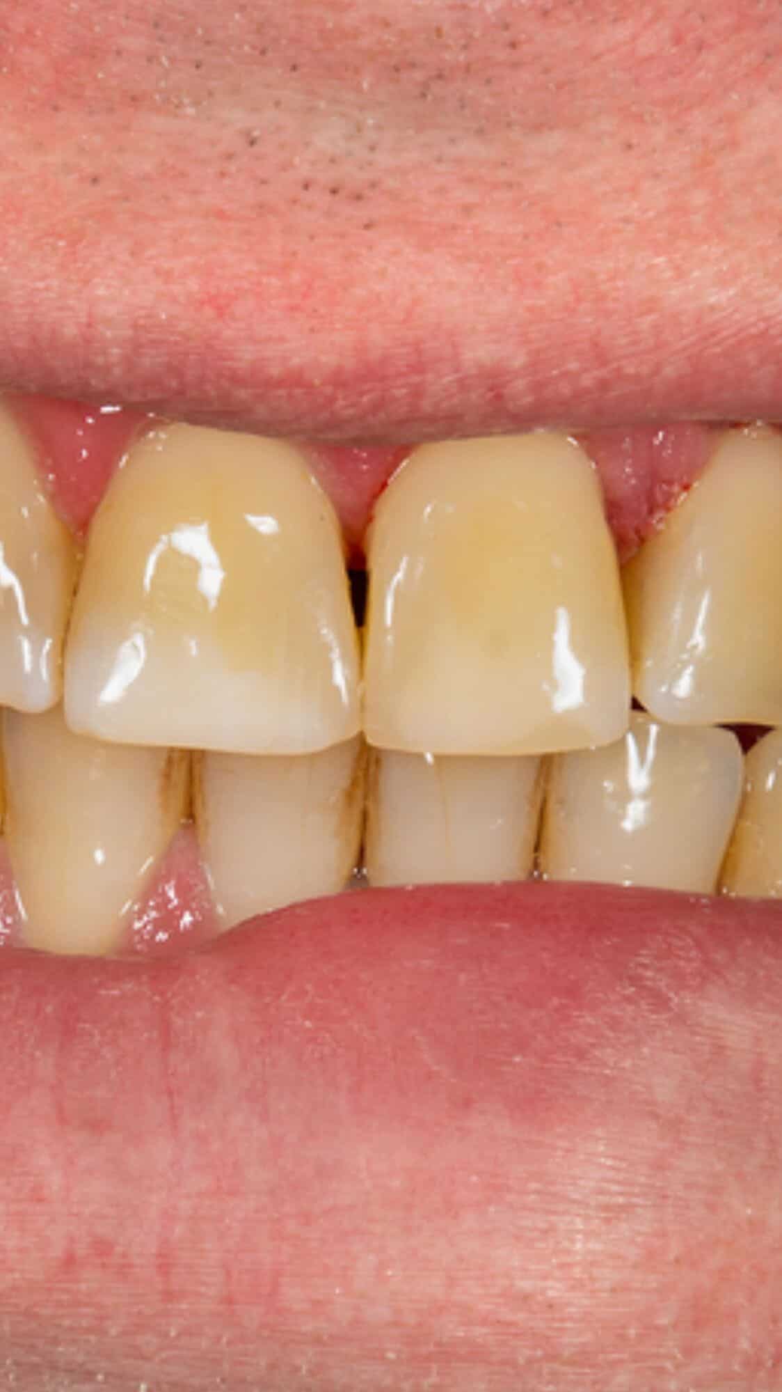 How to get rid of yellow teeth at home?