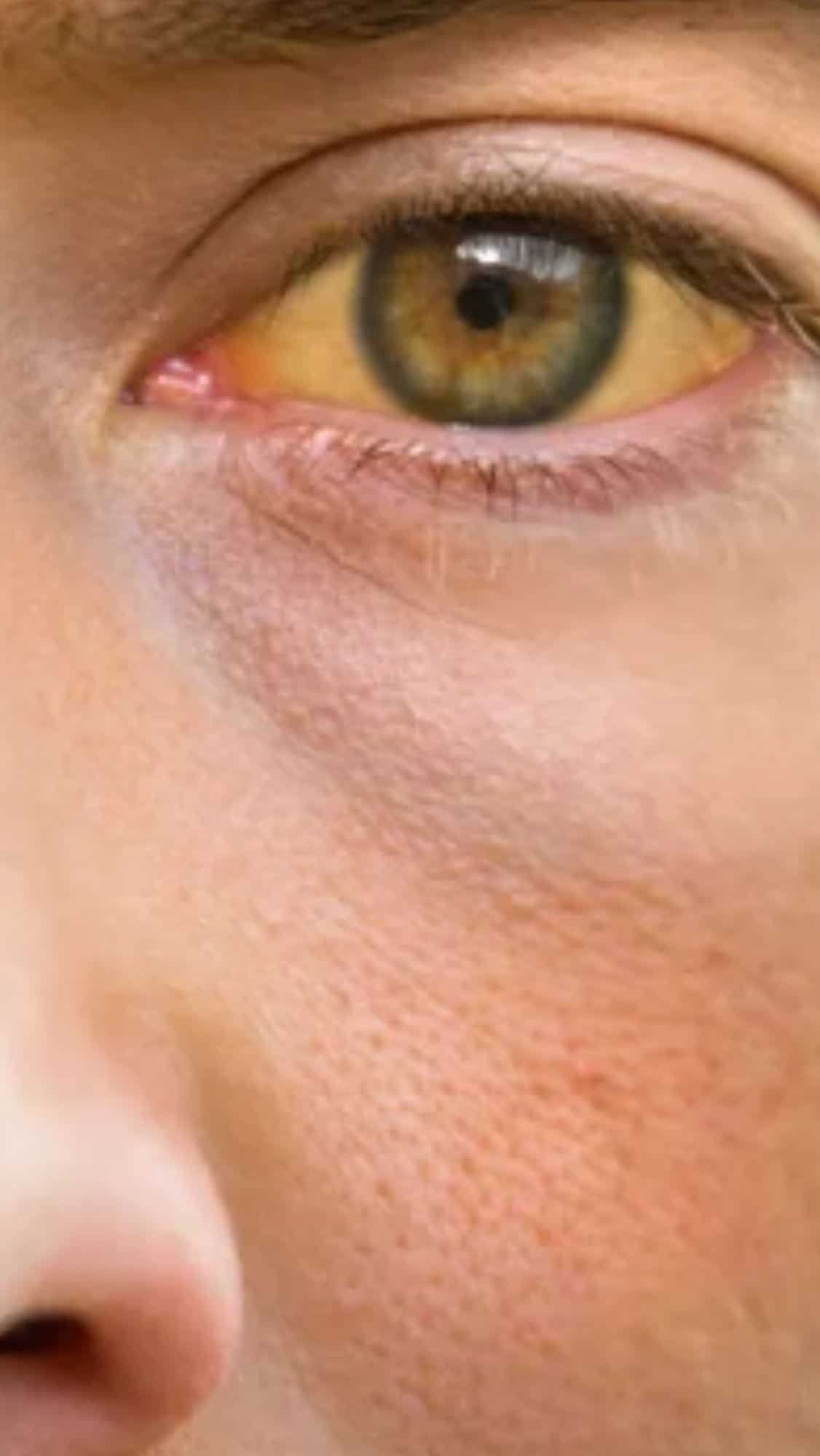 Foods to avoid during jaundice