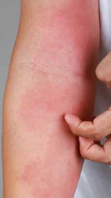 Zinc Deficiency Rash Face Zinc Deficiency Symptoms Skin